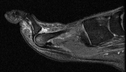 Figure 2 for case Plantar plate rupture